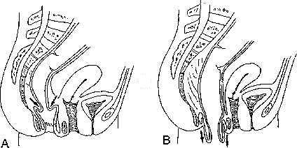 devin orear share extreme anal prolapse photos