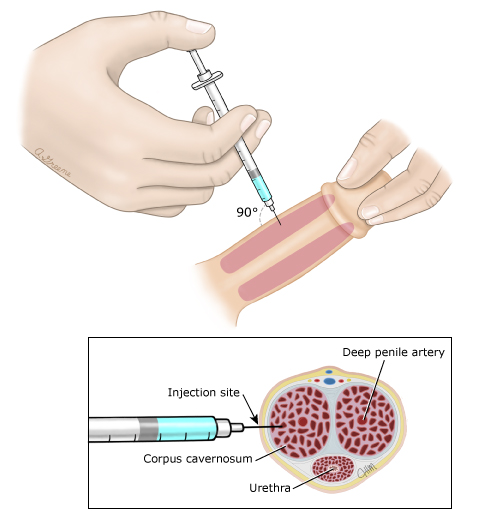 clarke macdonald recommends Injecting Cocaine Into Penis