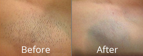 cherish inouye recommends Brazilian Wax Before And After Pictures