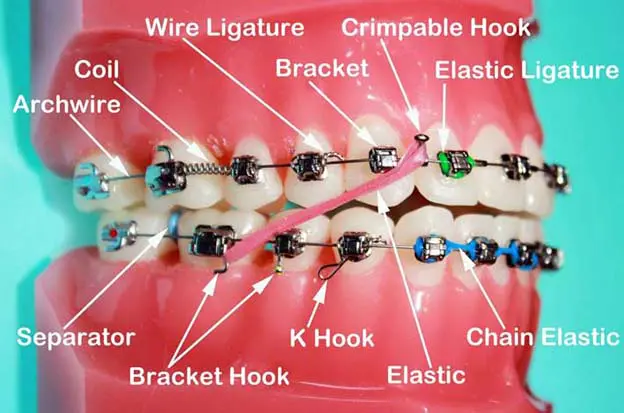 Best of I know that girl braces