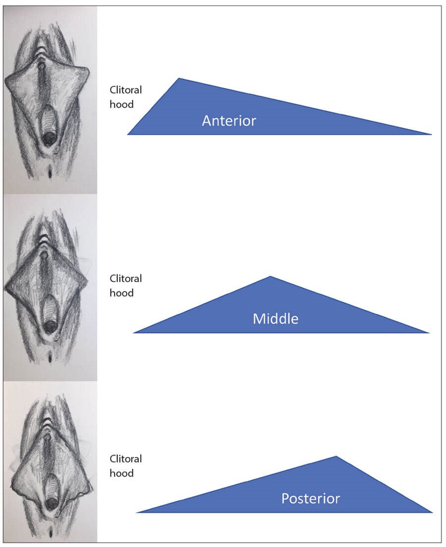 large labial folds