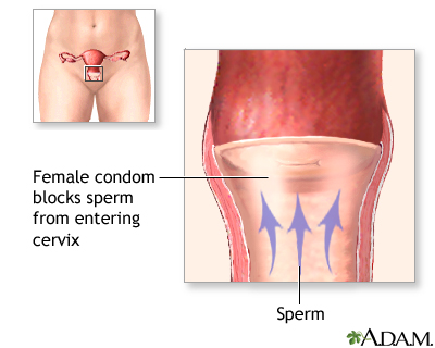 damien mc donald recommends female condom in use pictures pic