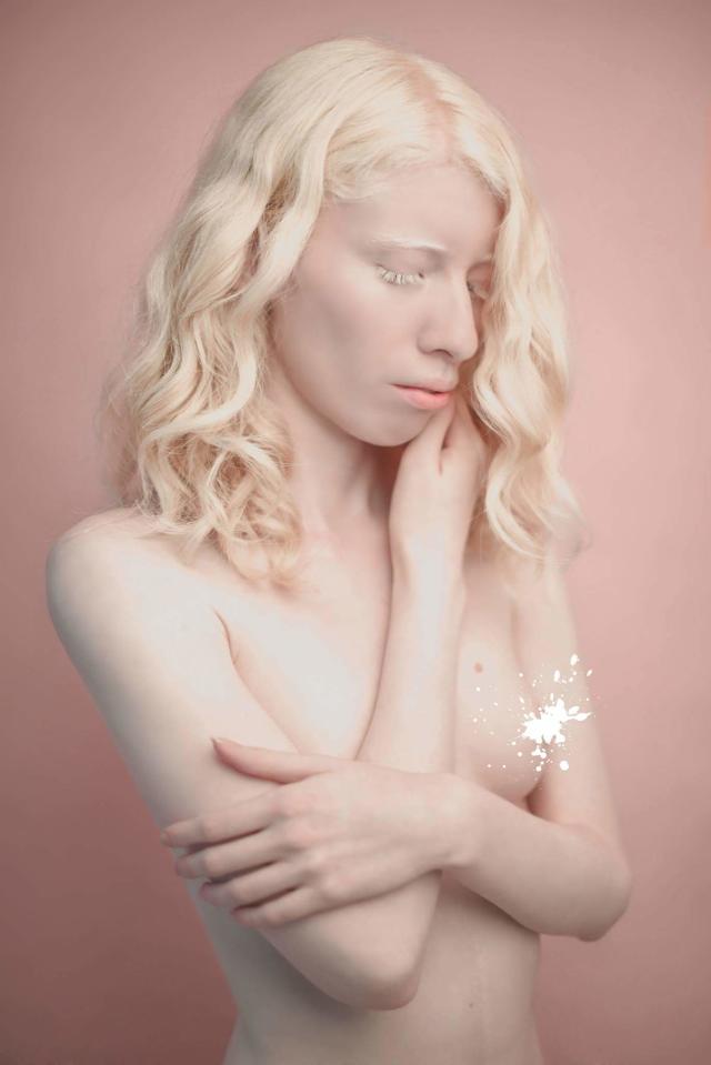 alex cressler share albino girl nude photos