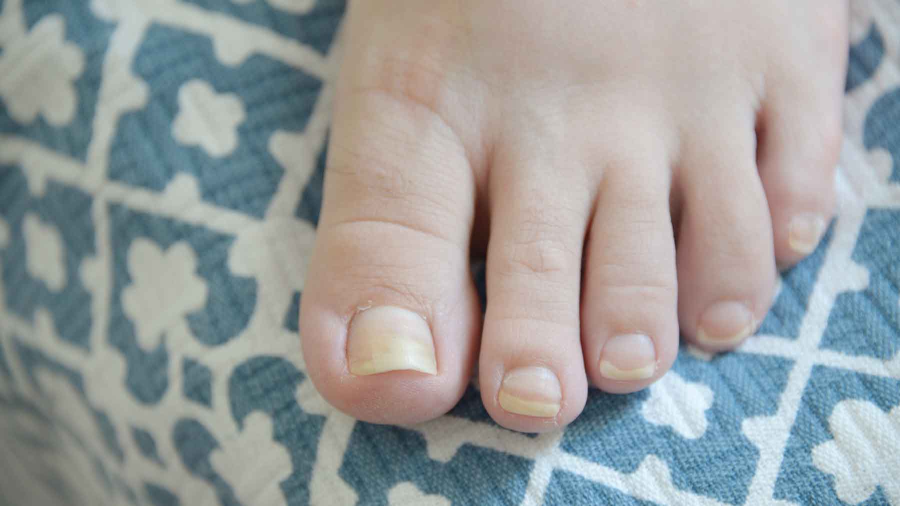 denise durand recommends what does white toes mean pic