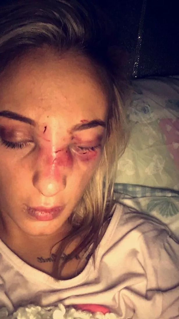 conrado bondoc recommends Girl Fight Broken Nose