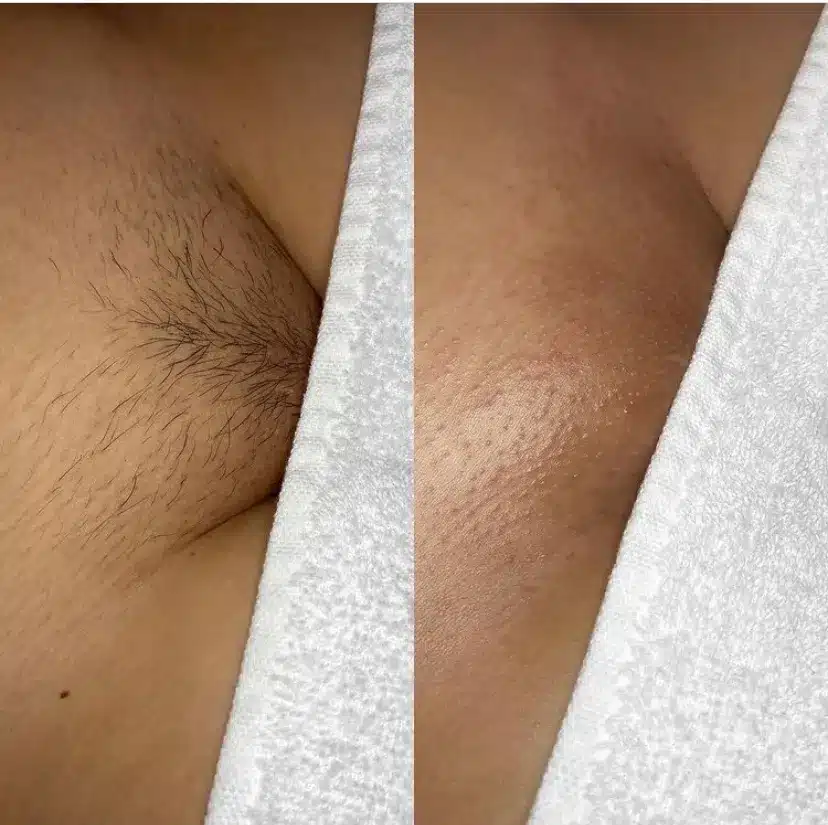christine lie recommends Full Brazilian Wax Pictures
