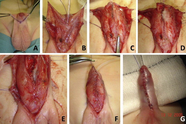 diana valentino recommends foreskin restoration before and after pic