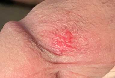 beverley purcell recommends Rug Burn On Penile Shaft