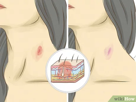 cindy fitzgibbons recommends How To Give Someone A Hickey