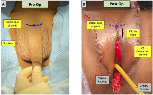 david c miles recommends how to remove hair from penis pic