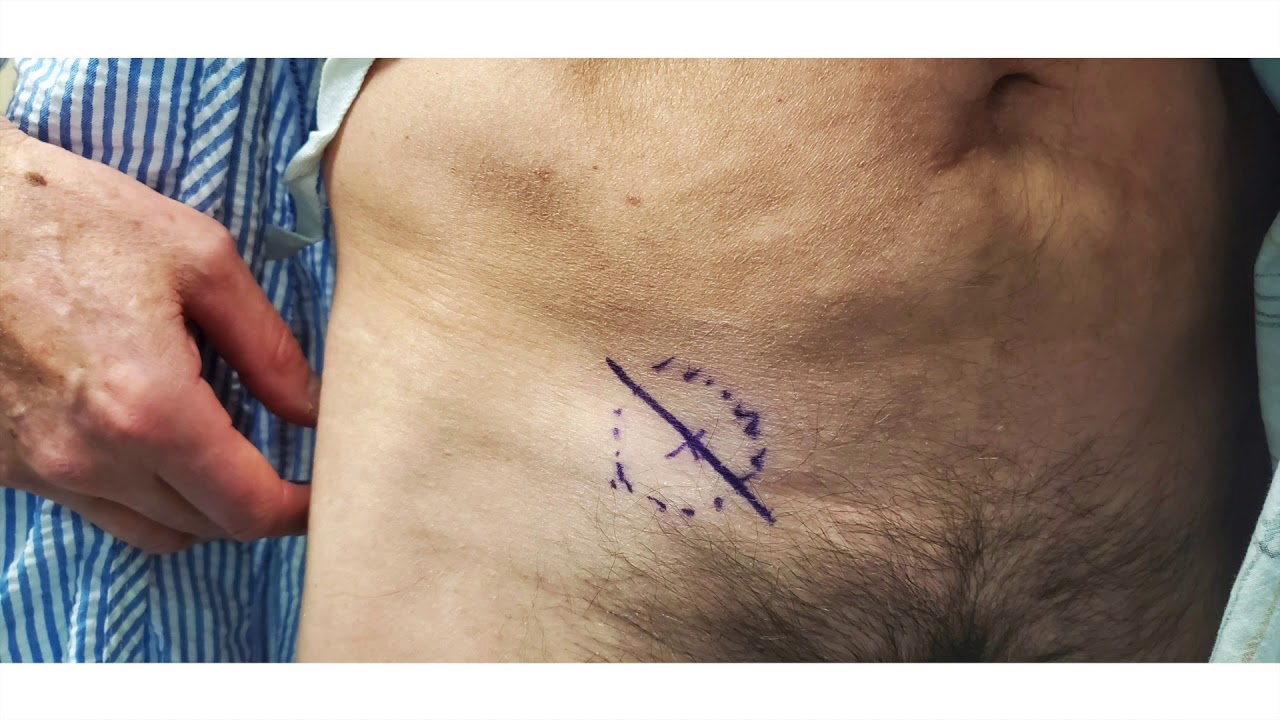 ally harrod recommends inguinal hernia exam video pic
