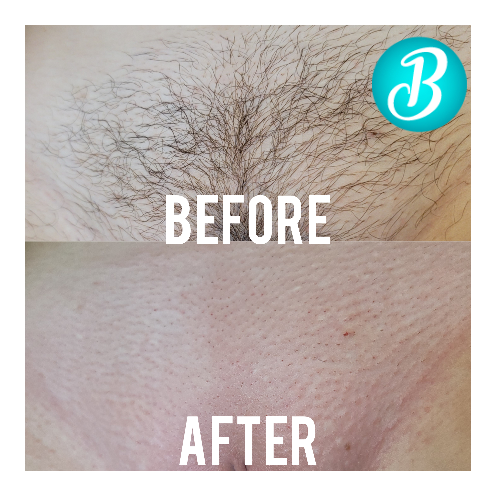 Brazilian Wax Before And After Pictures again mobile