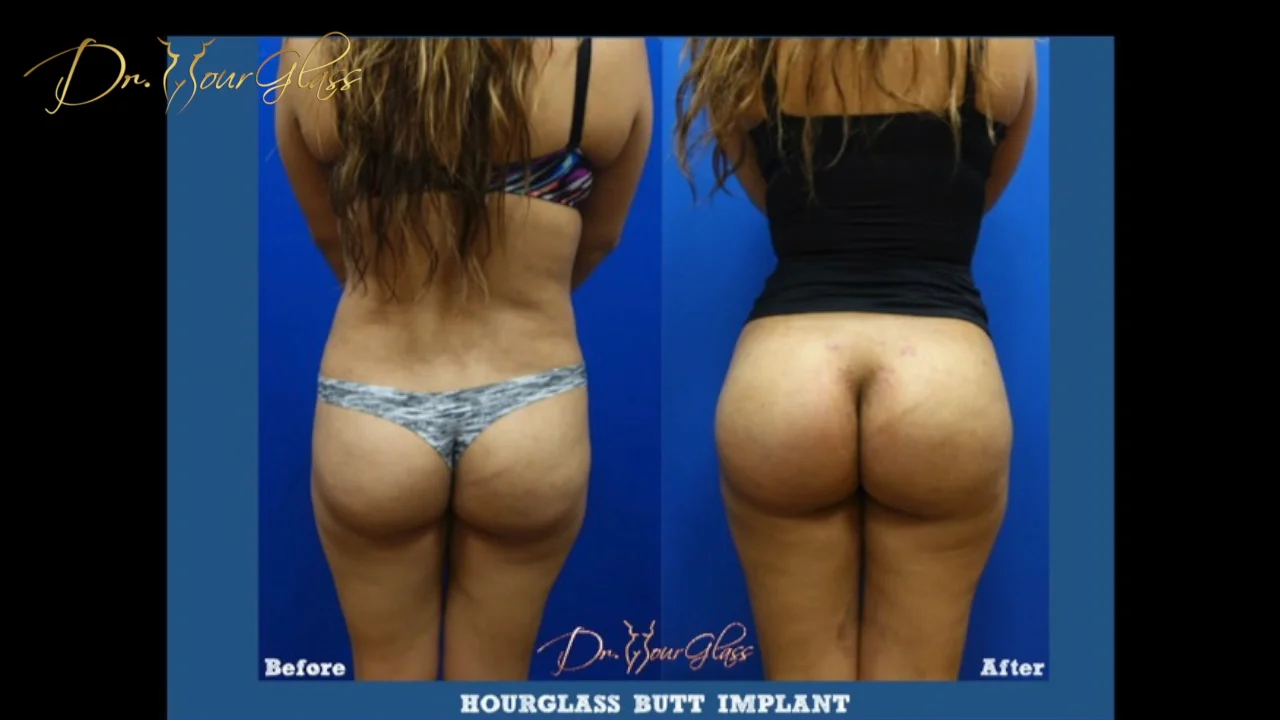 abraao santos recommends butt implants tumblr pic