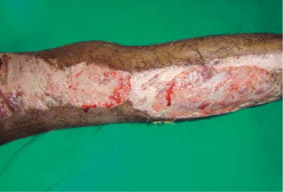 allan arnuco recommends rug burn on penile shaft pic