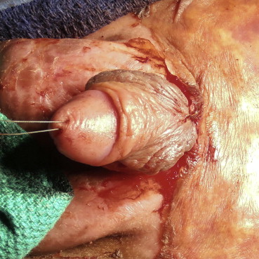 digna vasquez recommends rug burn on penile shaft pic