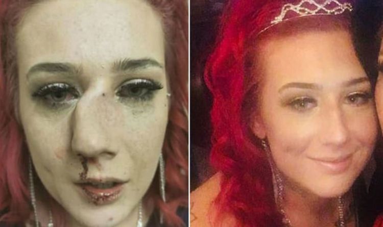 daniel driggers share girl fight broken nose photos